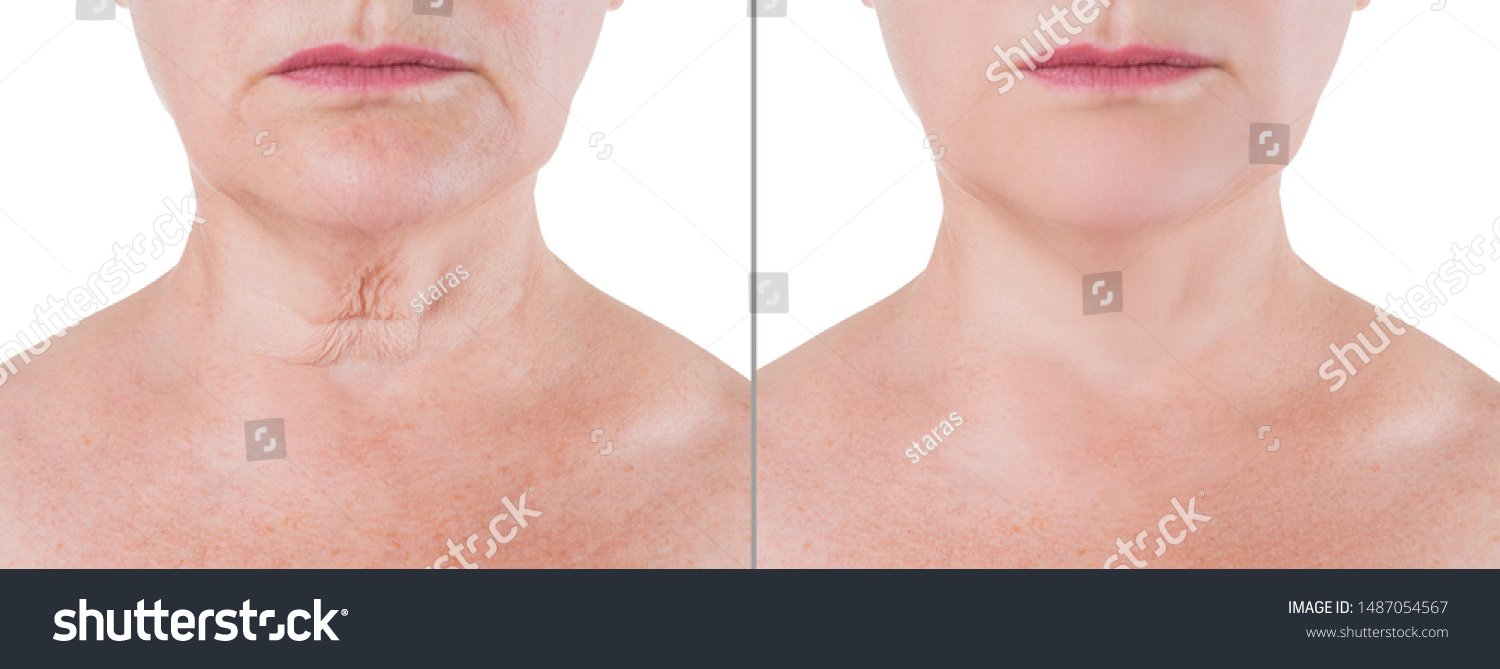 How Much Does a Neck Lift Cost Render Knowledge