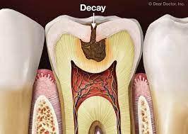 Tooth Loss Prevention